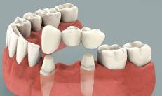 Какой зубной протез лучше поставить — мост, коронку или имплант, чем они отличаются?