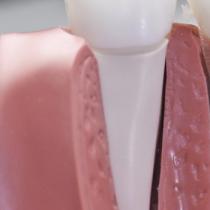 Преимущества процедуры по проведению наращивания зуба на штифт