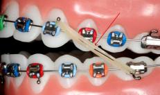 Ортодонтические резинки для брекетов